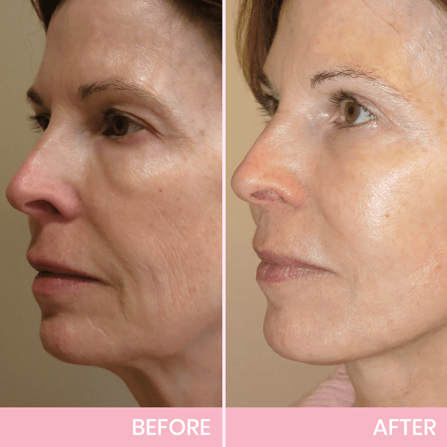 ✨ BBOJI™ Invisible Face Lift Tape 💖 Instantly Sculpt Your Jawline & Hide Double Chin