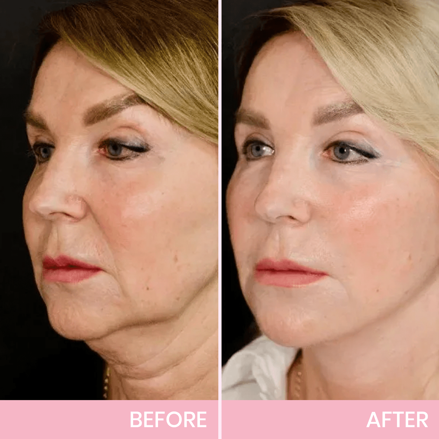 ✨ BBOJI™ Invisible Face Lift Tape 💖 Instantly Sculpt Your Jawline & Hide Double Chin