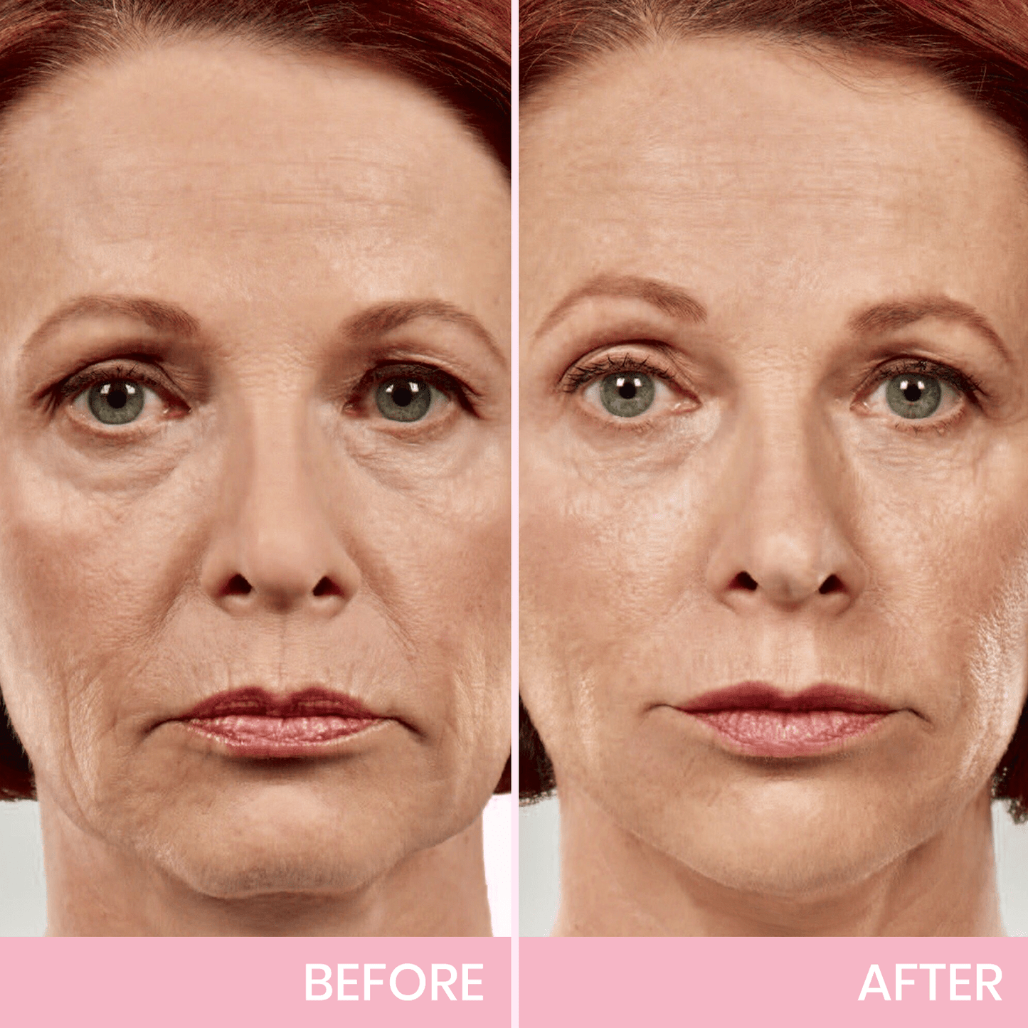 ✨ BBOJI™ Invisible Face Lift Tape 💖 Instantly Sculpt Your Jawline & Hide Double Chin
